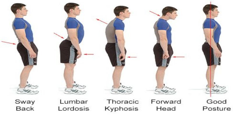 Image describing possible variations of bad posture, and what good posture should be.